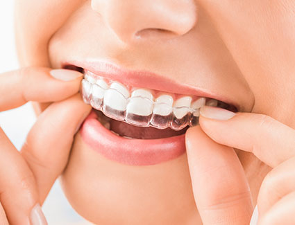 Aligner eingesetzt