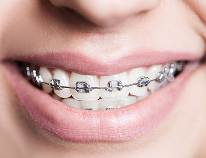 Metallbrackets