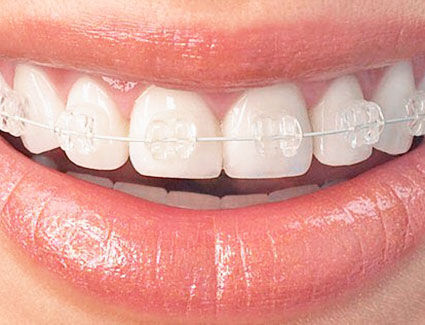 Saphirbrackets