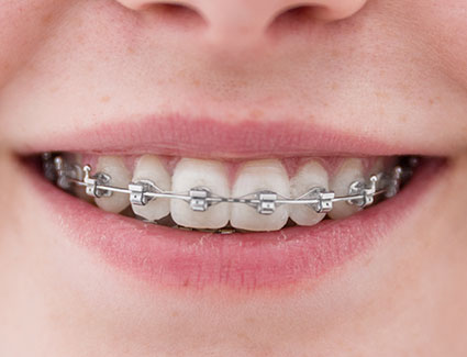 selbstlegierende Speed-Brackets
