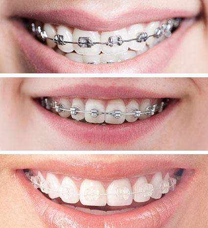 Brackets